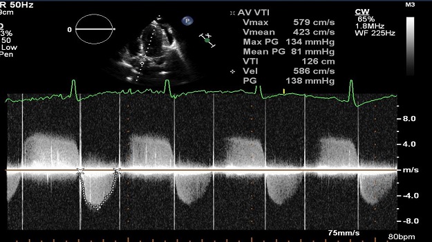 Prosthetic Valve Thrombosis 